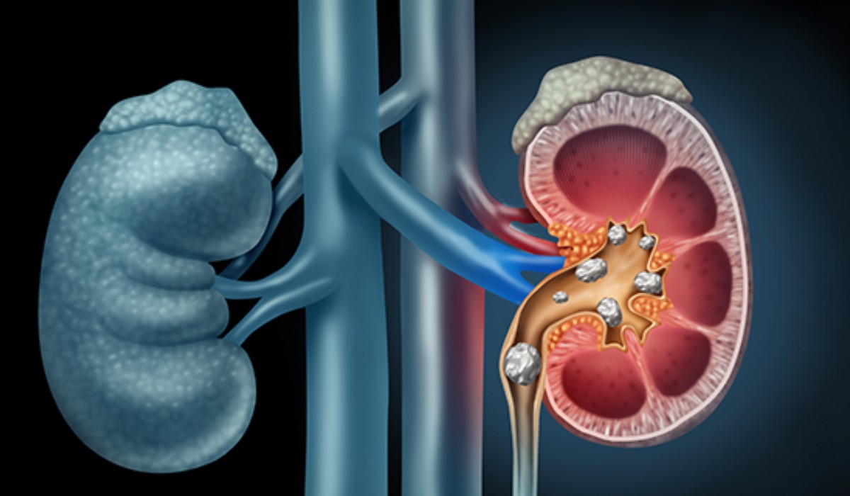 Urinary Stone Diseases 2